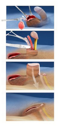 12553638-Male-female-sex-change-operation-illustration.jpg