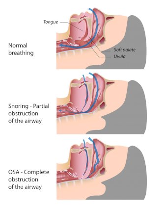 obstructive-sleep-apnea1.jpg