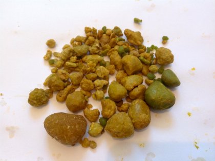 liver stones gallbladder stone.jpg
