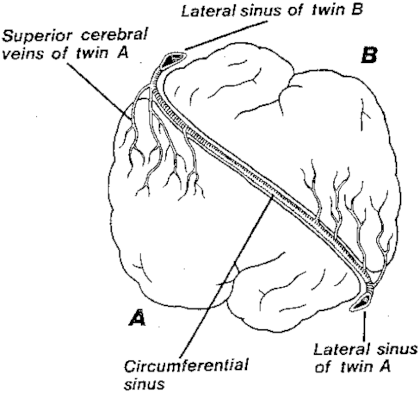 Circumferential-venous-sinus-of-total-vertical-craniopagus.png