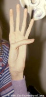 Marfan-5L-1557770711376.png