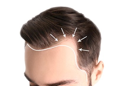 haartransplantation_geheimratsecken_mann_1379671064_430x300.jpg