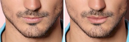 male-lip-filler-before-after.jpg