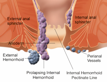 Internal_and_external_hemorrhoids.png