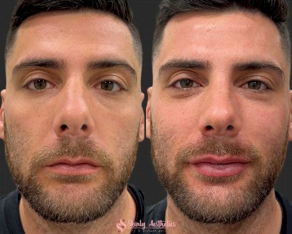 male-patient-with-lip-filler-injections.jpg