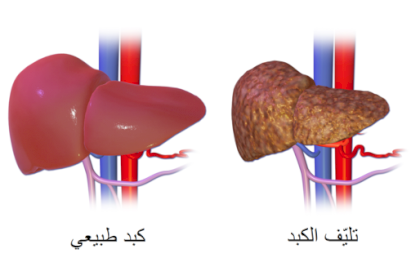 514px-Liver_Cirrhosis-ar.png