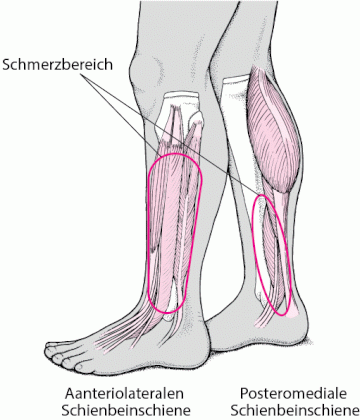 PHY_shin_splints_de.gif